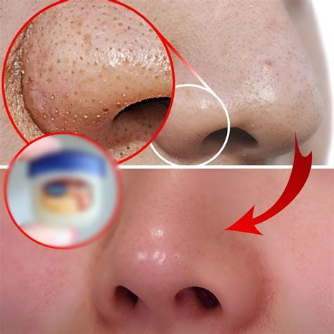 Is Unbelievable Blackhead Removal 2024 Worth The Hype? Image 9