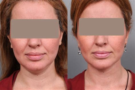 smartlipo liposuction    patient  nyc dr