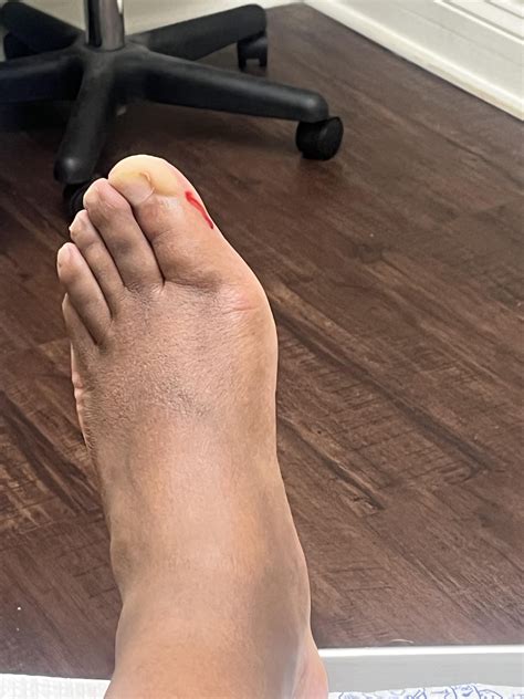 Never felt better! : r/Ingrown_Toenails