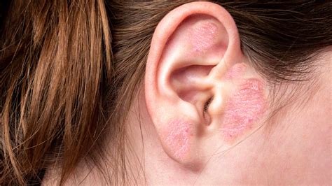 ear eczema  symptoms treatment options