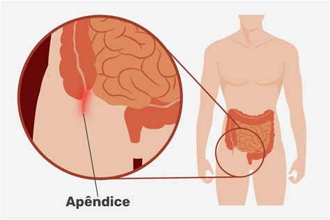 O Que Que é Apêndice - 5