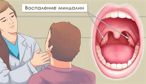 Гнойные пробки в горле: причины появления и как избавиться от них