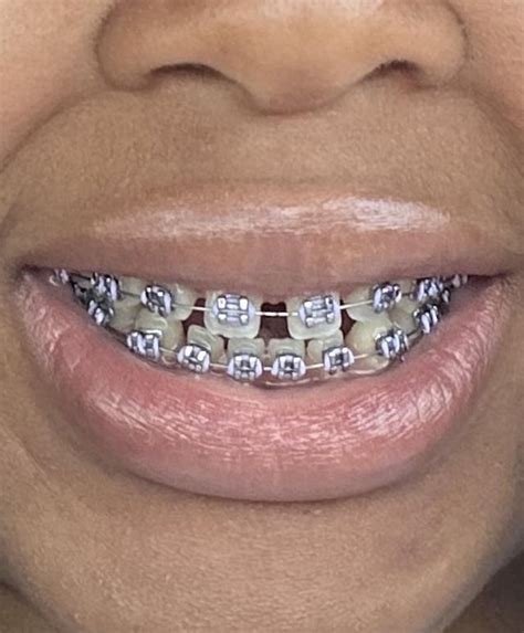 slightly disillusioned  braces rbraces