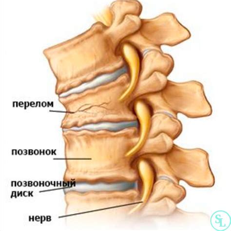 Перелом позвоночника - лечение, операция и реабилитация позвонка