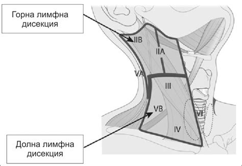 Лимфна дисекция