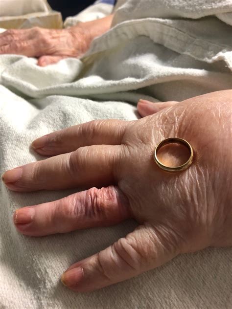 approach  ring removal compression device jems ems