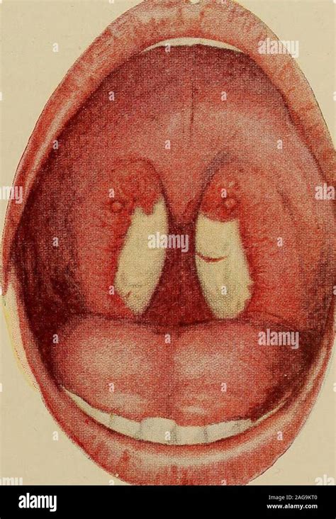 Pharyngeal diphtheria hi-res stock photography and images - Alamy