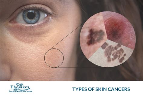 Types of Skin Cancers - The Lakes Family Medical Centre