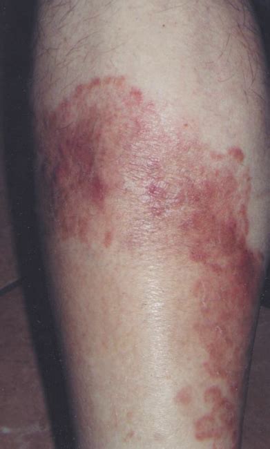 Diabetic Skin Rash Pictures Effective Health - vrogue.co