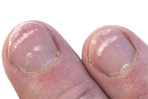 black color toenail 1