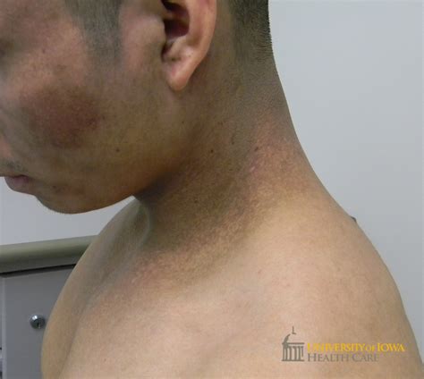 Lichen Planus Da Stress 6