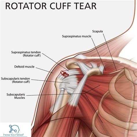 rotator cuff tear symptoms shoulder impingement rotator cuff
