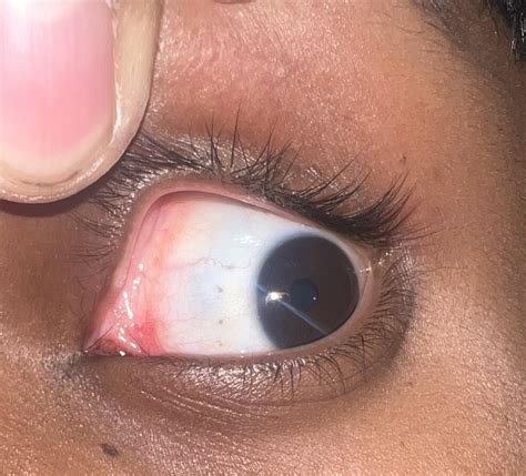 Black dots on eyeball : r/medical