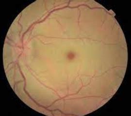 Retinal Artery Occlusion - Optometrists.org