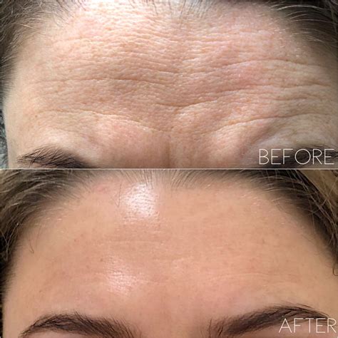 forehead before and after | Fibroblast Plasma Pen