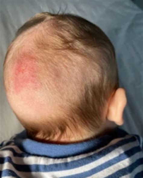 The Neighborly - Your Baby’s Skin & Scalp Most bumps and rashes you may