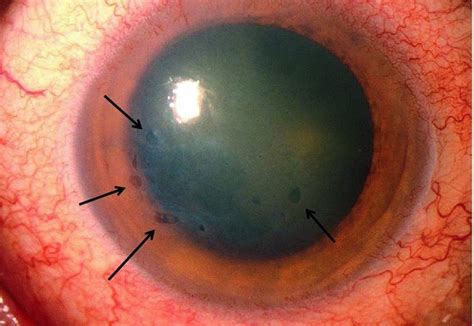 bullous keratopathy ophthalmology merck manual professional edition