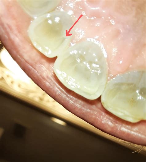 Back of teeth chipping? : r/askdentists