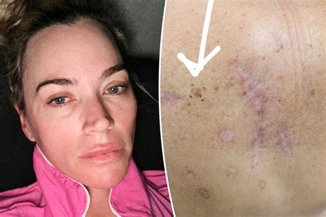 Teary-eyed Teddi Mellencamp reveals she has another melanoma amid