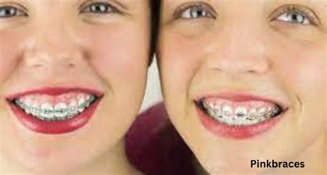 Best braces colors for you in 2023 » pink braces