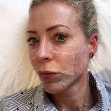 My Eyelid Is Swollen But No Pain Reddit - Infoupdate.org