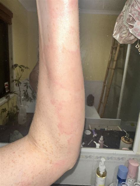 circular type rash rdermatologyquestions