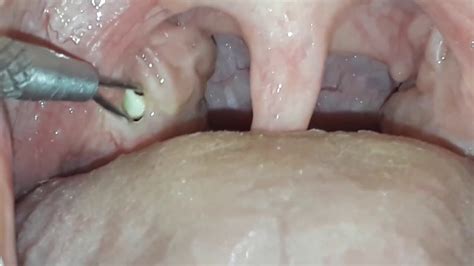 tonsil stones removal - YouTube