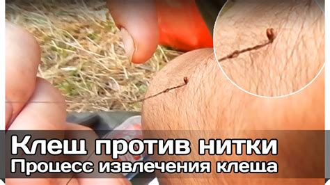 [РВ] Извлечение клеща ниткой (укус клеща весной и его удаление нитью ...