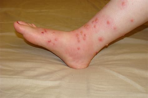 Poison Oak Rash Pictures On Legs at Josh Pitre blog