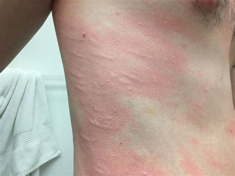 I have some type of marks on skin wondering if anyone has seen this ...