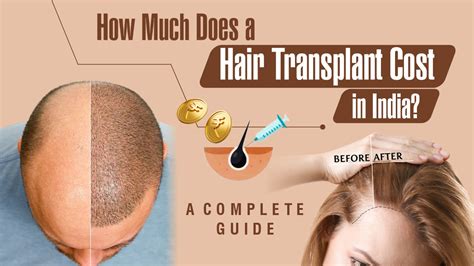 hair transplant cost  india  complete guide