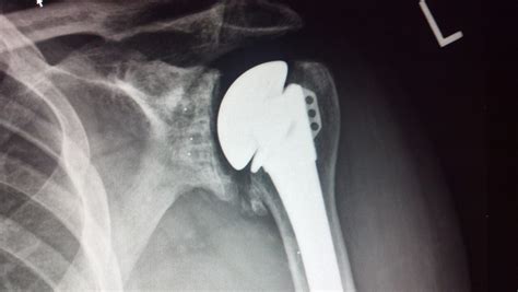 Arthroplasty of the Shoulder : Wheeless' Textbook of Orthopaedics