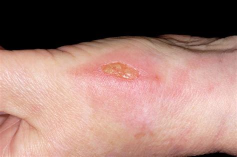 infected wound