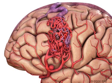 Arteriovenous Malformation Images - AANS/CNS Cerebrovascular Section