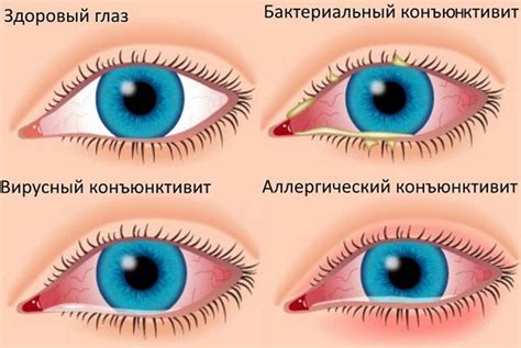Конъюнктивит у ребенка: лечение, признаки, симптомы детского ...