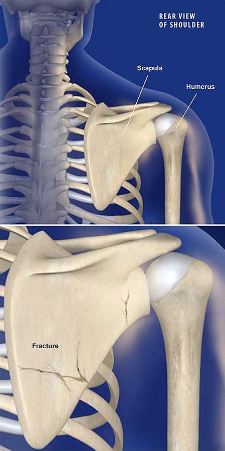 Fractures of the Shoulder Blade (Scapula) | Central Coast Orthopedic ...