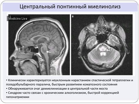 Псевдобульбарный паралич - презентация онлайн