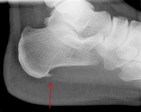 bone spur  symptoms   treatments healdove