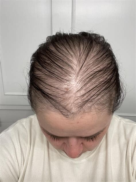 4 months postpartum balding : r/FemaleHairLoss