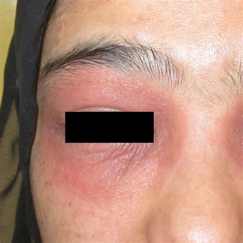 Allergic Contact Dermatitis – DermAlive