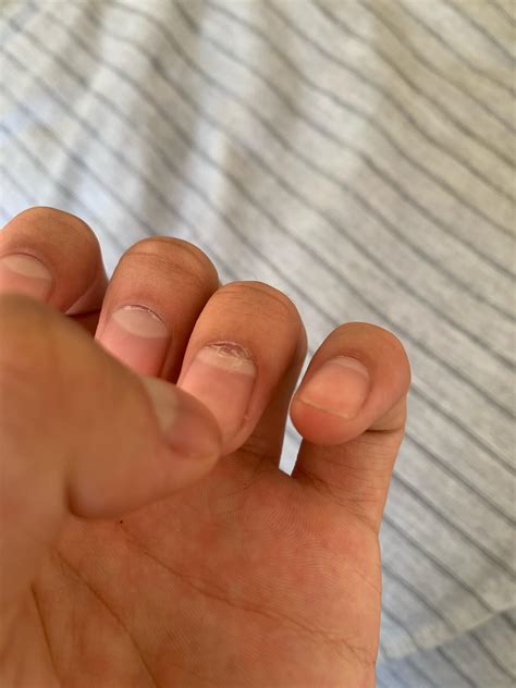 my nail is growing out broke : r/medical_advice