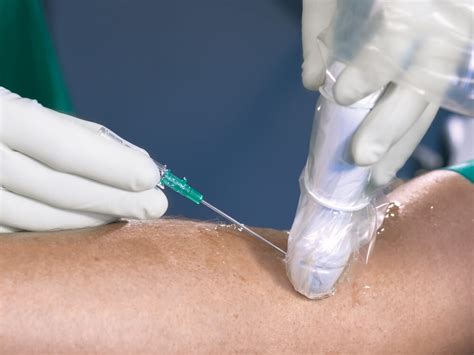 Ultrasound-guided Long Peripheral IV Catheter (USG Long PIVC) - B. Braun