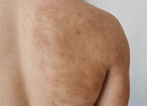 Becker's Nevus at Hunter Wang blog