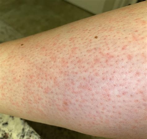 What are these itchy red bumps? : r/DermatologyQuestions