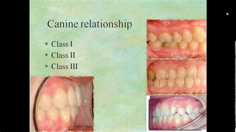 clase ii canina bilateral  tratamiento de clases ii