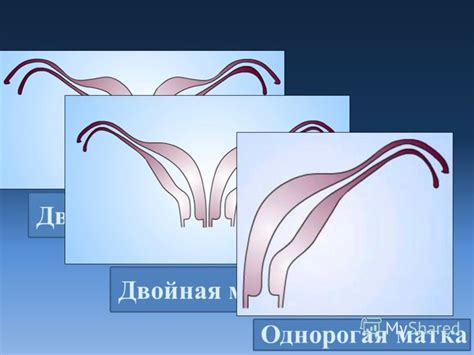 Презентация на тему: "Седловидная матка. Двурогая матка Двойная матка ...