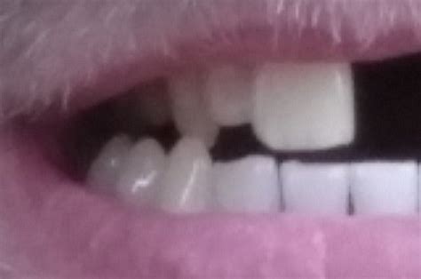 What's The Strangest Way You've Lost A Tooth?