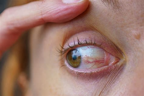 Eye Conditions & Diseases | Diagnosis & Treatment