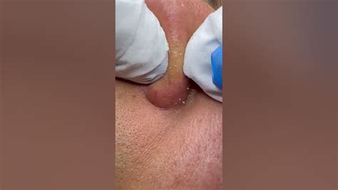 Unbelievable Blackhead & Fat Removal Extraction with Dr. Dahabra | Must ...
