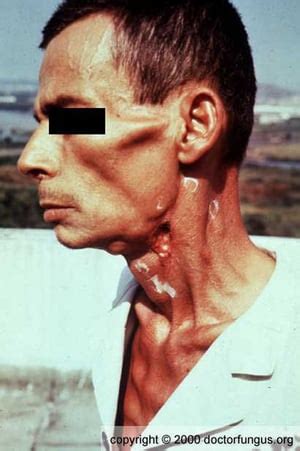 Paracoccidioidomycosis - Infectious Diseases - Merck Manual ... 